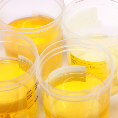 Concentrating on concentration – getting urinary iodine right!